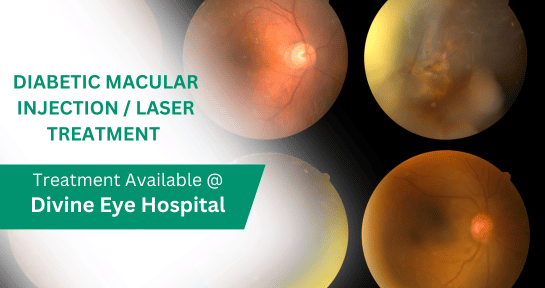 Diabetic Macular Injection & Laser Treatment in Panchkula