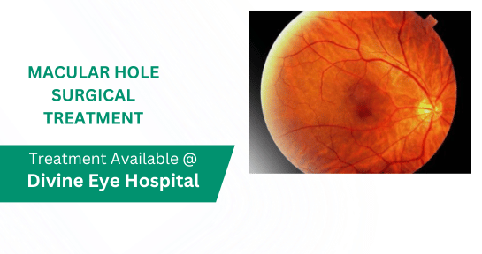 Macular Hole Surgical Treatment in Panchkula